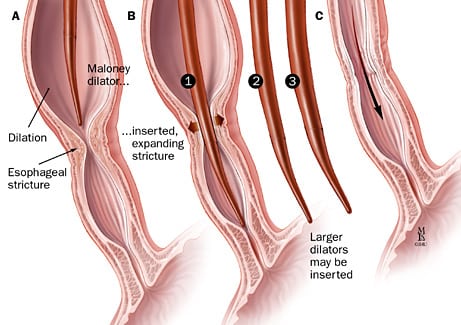 Esophageal-Dilation