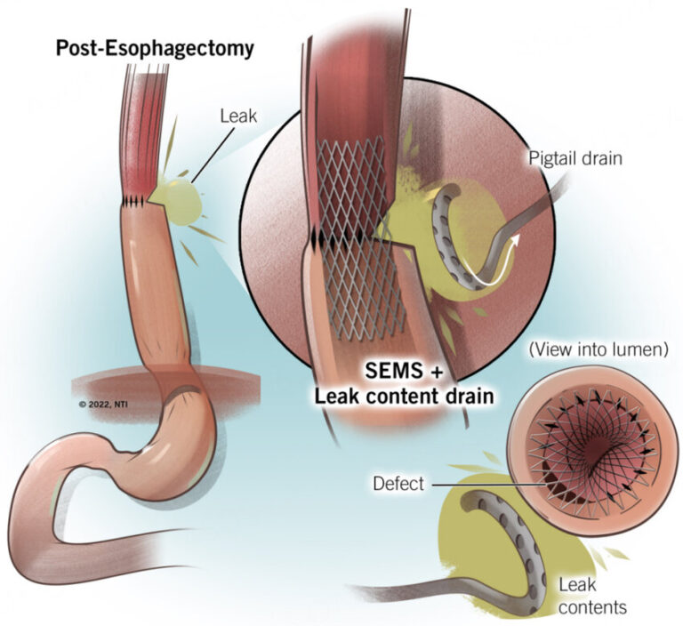 Illustration-of-a-self-expandable-metallic-stent-SEMS-used-for-the-endoscopic