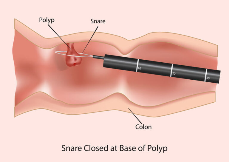 Polypectomy