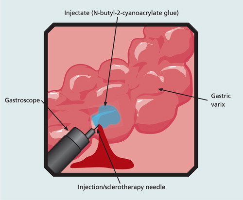 glue-injection-gastric-varices